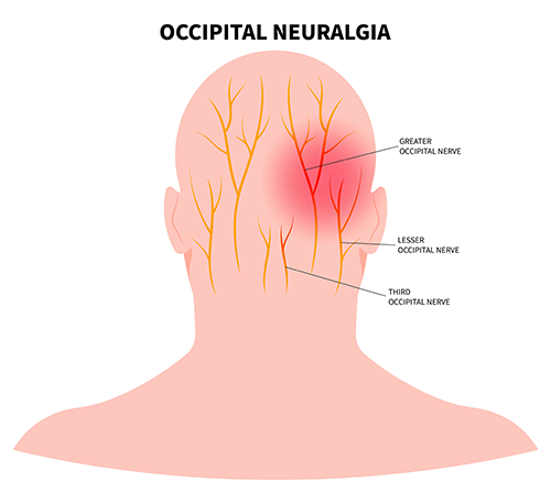 Village Family Clinic - Occipital Neuralgia