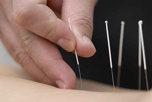 Acupuncture - Village family Clinic