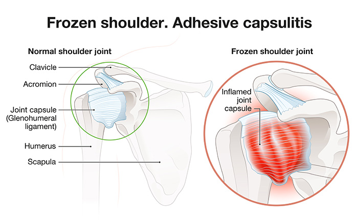 Village Family Clinic - Frozen Shoulder