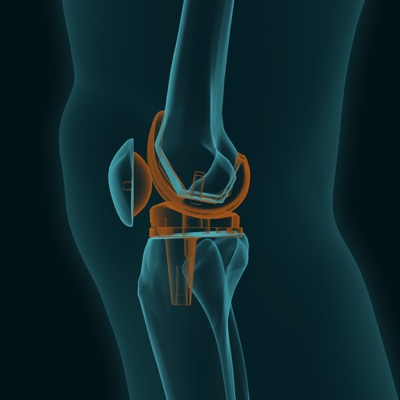 Village Family Clinic - Total Knee Replacement Hackettstown, NJ
